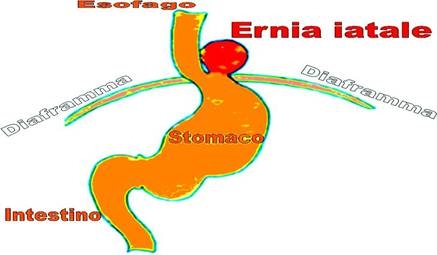 come curare l'ernia iatale, reflusso gastro esofago, ernia cause, curare l'ernia iatale, 